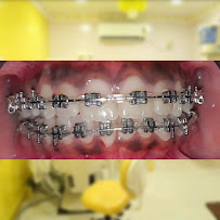 VIGNESH'S DENTAL ZONE (Advanced Implant, RCT, Braces, Pediatric, Invisalign & FMR Centre)