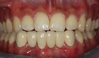 Tooth Craft Multispeciality-Best dentist in Ashoknager- Invisalign, Implants,Braces,Veneers,Rootcanal
