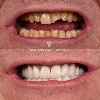 Diamond Dental Antalya | Diş Hekimi - Diş Polikliniği | Implant, Veneer, Crowns Dentist