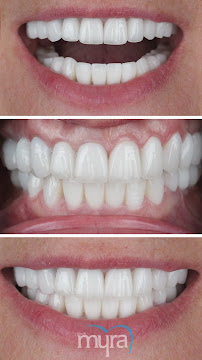 Myra Dental Centre Turkey (Veneers Turkey, Crowns Turkey, Dental Implants Turkey, Dentist Turkey, Teeth Whitening)