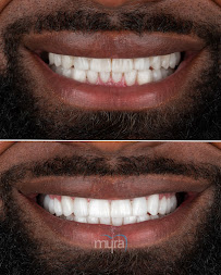 Myra Dental Centre Turkey (Veneers Turkey, Crowns Turkey, Dental Implants Turkey, Dentist Turkey, Teeth Whitening)