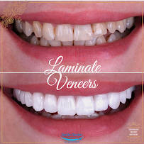 Smile Center Turkey® (Dentist in Antalya | Dental Veneers | Hollywood Smile | Smile Makeover | E-Max Laminate Veneers)