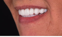 Smile Center Turkey® (Dentist in Antalya | Dental Veneers | Hollywood Smile | Smile Makeover | E-Max Laminate Veneers)
