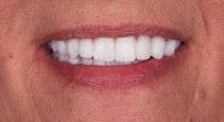 Smile Center Turkey® (Dentist in Antalya | Dental Veneers | Hollywood Smile | Smile Makeover | E-Max Laminate Veneers)