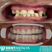 DentAntalya (Oral & Dental Health Clinic)