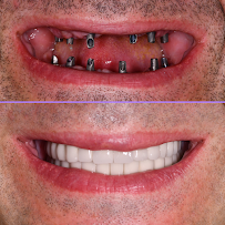 Özel IDH Süleyman Mert Ağız ve Diş Sağlığı Merkezi - Antalya Diş Hekimi - Antalya Dentist