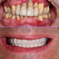 Özel IDH Süleyman Mert Ağız ve Diş Sağlığı Merkezi - Antalya Diş Hekimi - Antalya Dentist