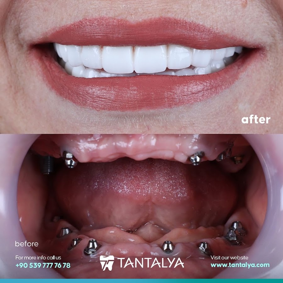 Tantalya dental clinic in Antalya