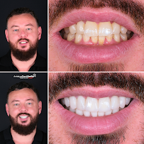 Antalya Dent Smile (Dental Implants, Crowns, Veneers & Invisalign)