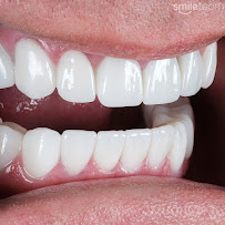 Smile Team Turkey - (Dental Implants, Crowns, Veneers & Teeth Whitening)