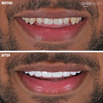 Smile Team Turkey - (Dental Implants, Crowns, Veneers & Teeth Whitening)
