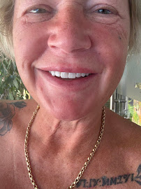 Smile Team Turkey - (Dental Implants, Crowns, Veneers & Teeth Whitening)