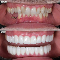 Smile Team Turkey - (Dental Implants, Crowns, Veneers & Teeth Whitening)