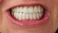 ES Clinic Turkey | Excellent Smile Clinic
