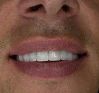 Dental Clinic in İstanbul - Aesthetic Teeth - Teeth Whitening and Veneer - Smile Design - Inlay Onlay