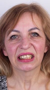 Dental Clinic in İstanbul - Aesthetic Teeth - Teeth Whitening and Veneer - Smile Design - Inlay Onlay