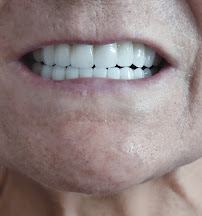 Dental Clinic in İstanbul - Aesthetic Teeth - Teeth Whitening and Veneer - Smile Design - Inlay Onlay