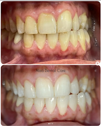 Alisa Dental Care | Dental Clinic in Richmond Town, Bangalore