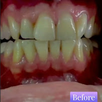 Alisa Dental Care | Dental Clinic in Richmond Town, Bangalore