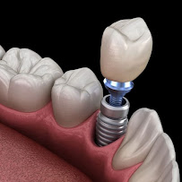 TurSmile Antalya - ( Dental Implants, Veneers & Turkey Teeth)