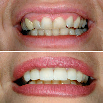 TurSmile Antalya - ( Dental Implants, Veneers & Turkey Teeth)