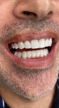 TurSmile Antalya - ( Dental Implants, Veneers & Turkey Teeth)