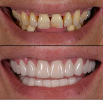 TurSmile Antalya - ( Dental Implants, Veneers & Turkey Teeth)