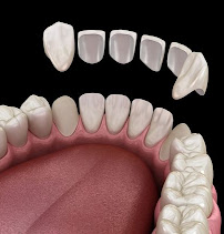 TurSmile Antalya - ( Dental Implants, Veneers & Turkey Teeth)