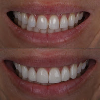 TurSmile Antalya - ( Dental Implants, Veneers & Turkey Teeth)