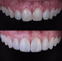 TurSmile Antalya - ( Dental Implants, Veneers & Turkey Teeth)