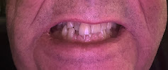 İzy Dentiste Clinique dentaire Turquie : implants, couronnes, facettes. Tourisme dentaire