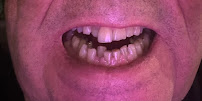 İzy Dentiste Clinique dentaire Turquie : implants, couronnes, facettes. Tourisme dentaire