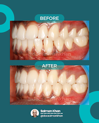 Dr. Braces - Best Invisalign Provider & Dental Clinics in BTM, Bangalore | HSR Layout, Indiranagar, Jayanagar, RR Nagar