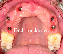 EVA Esthetic & Implant Dental Centre-Nagawara,Bangalore,India | Implantologist/Full Mouth Implant Specialist |
