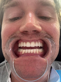 Bali Smile Teeth Whitening