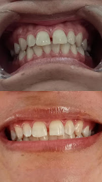 Bali Smile Teeth Whitening