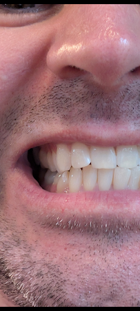 Bali Smile Teeth Whitening
