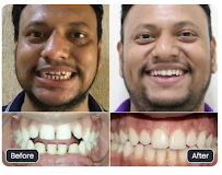 Toothsi by MakeO | Invisible Braces & Aligners | Jayanagar