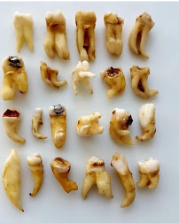 SK Dental Care and Implant Centre - Root canal treatment, extraction, teeth cleaning dentist in Murugeshpalya