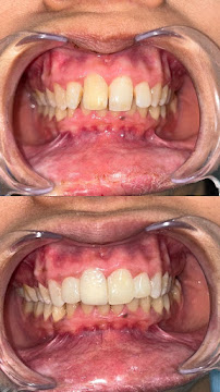 Mico Dental Clinic (A multi speciality dental, implant , Invisalign ® provider ,RCT and wisdom tooth centre )