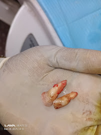 Mico Dental Clinic (A Multi Speciality Dental,Implant,Invisalign ® provider ,RCT and wisdom tooth centre 24/7 for emergency)