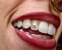 Mico Dental Clinic (A Multi Speciality Dental,Implant,Invisalign ® provider ,RCT and wisdom tooth centre 24/7 for emergency)