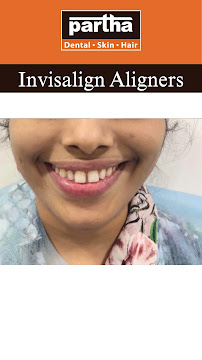 Partha Dental Clinic -Banswadi, Bangalore | Invisalign Provider | Braces, Root Canal & Dental Implants