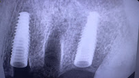 CITY DENTAL IMPLANT & AESTHETIC CLINIC | Dental Implants & Aligners in Mumbai