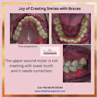 The Braces Point