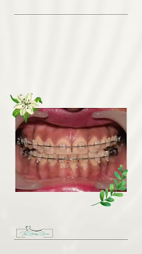 The Bombay Braces