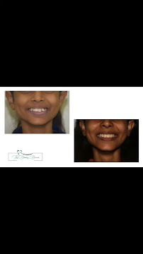 The Bombay Braces
