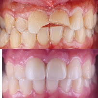 Dental implants and Root canal specialist