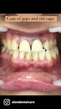 Sion Dental Care : Best Root Canal & Implant Specialist | Smile Design | Cosmetic Dentist | Wisdom Tooth & Gum Doctor in Sion