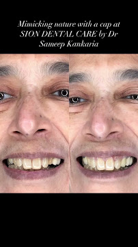 Sion Dental Care : Best Root Canal & Implant Specialist | Smile Design | Cosmetic Dentist | Wisdom Tooth & Gum Doctor in Sion